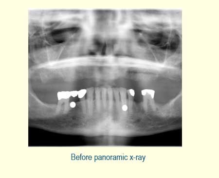Full Arch Case Study