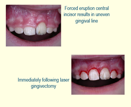 Laser Gingivectomy Case Study