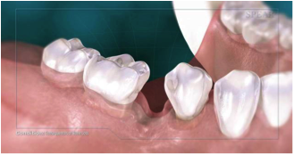 dental-implants2